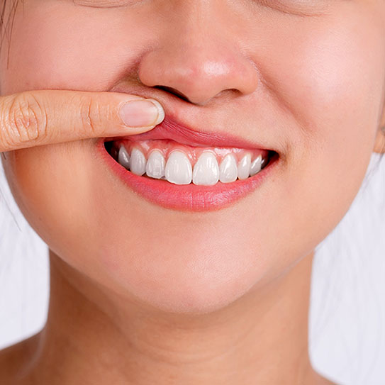 How Can I Defend Against Gum Recession? Denison IA Broadway Dental